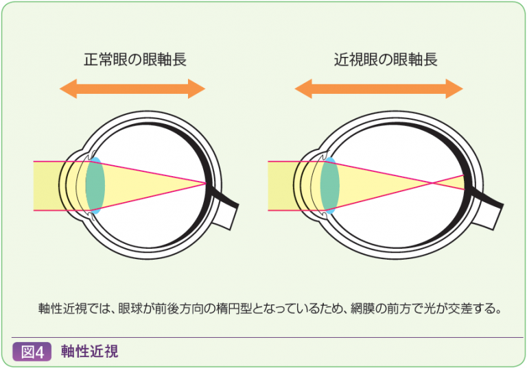 特集 近視の世界に光を | ファーマスタイルWEB